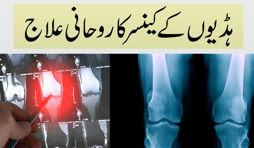 Haddiyon Ke Cancer Ka Rohani Ilaj