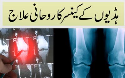Haddiyon Ke Cancer Ka Rohani Ilaj